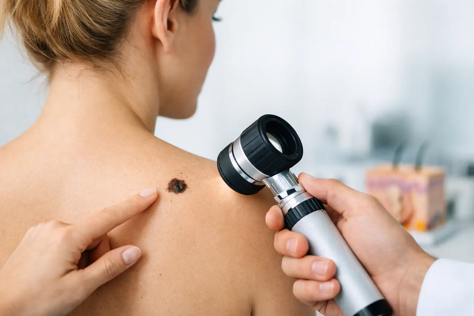Guía para detectar melanoma temprano